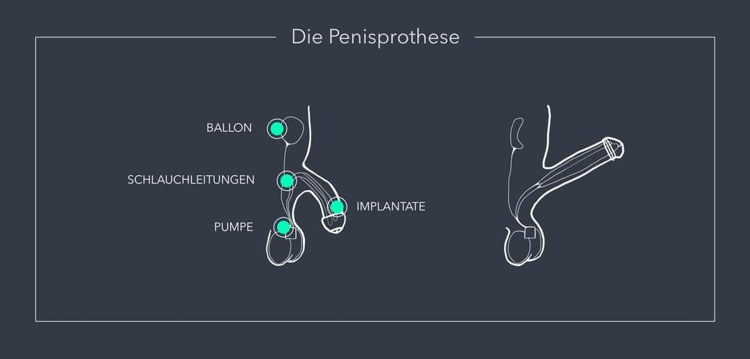 Funktionsweise Penisprothese